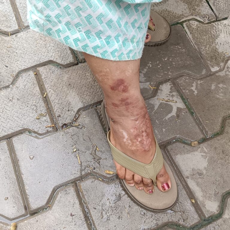 Sewerage illness